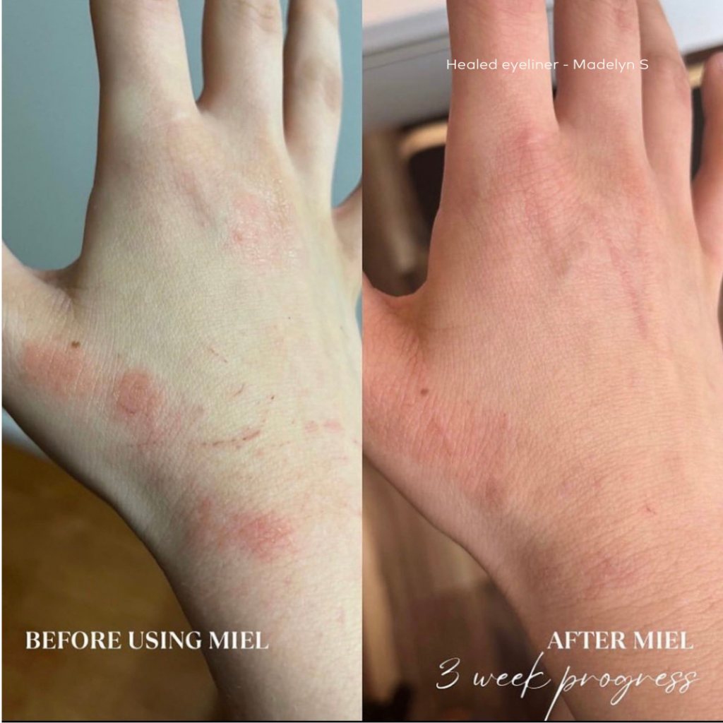 A comparison of a human hand before eczema care and after it. 